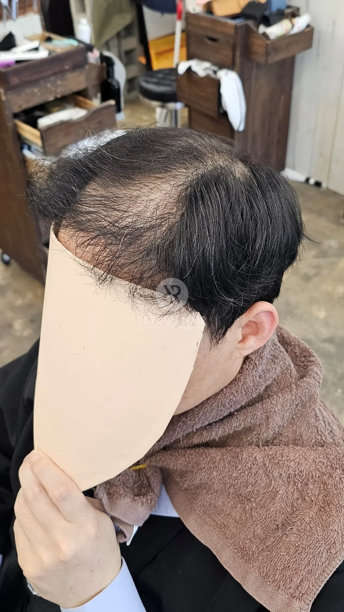 탈모 치트펌 파마 시술 전 사진 3