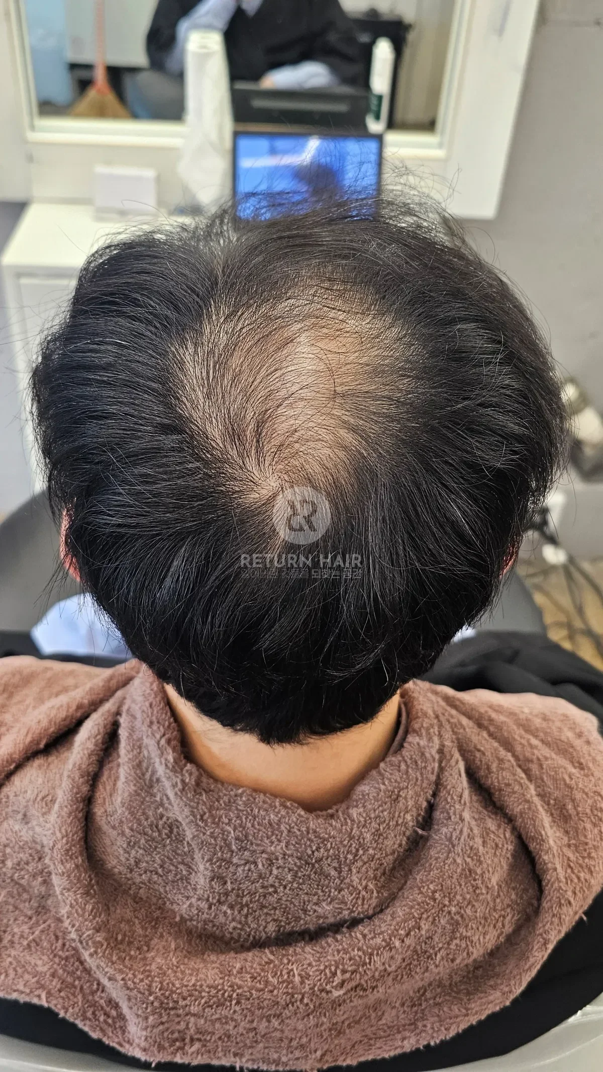 탈모 치트펌 파마 시술 전 사진 4