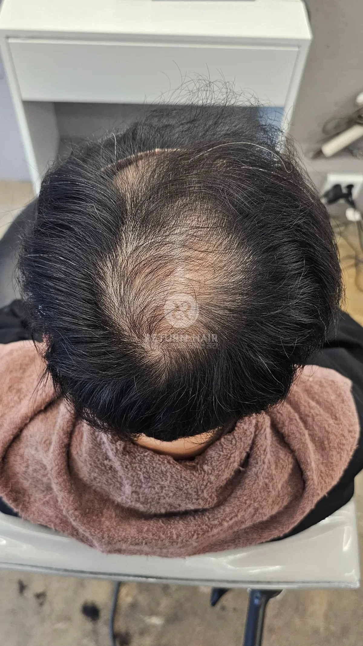 탈모 치트펌 파마 시술 전 사진 5