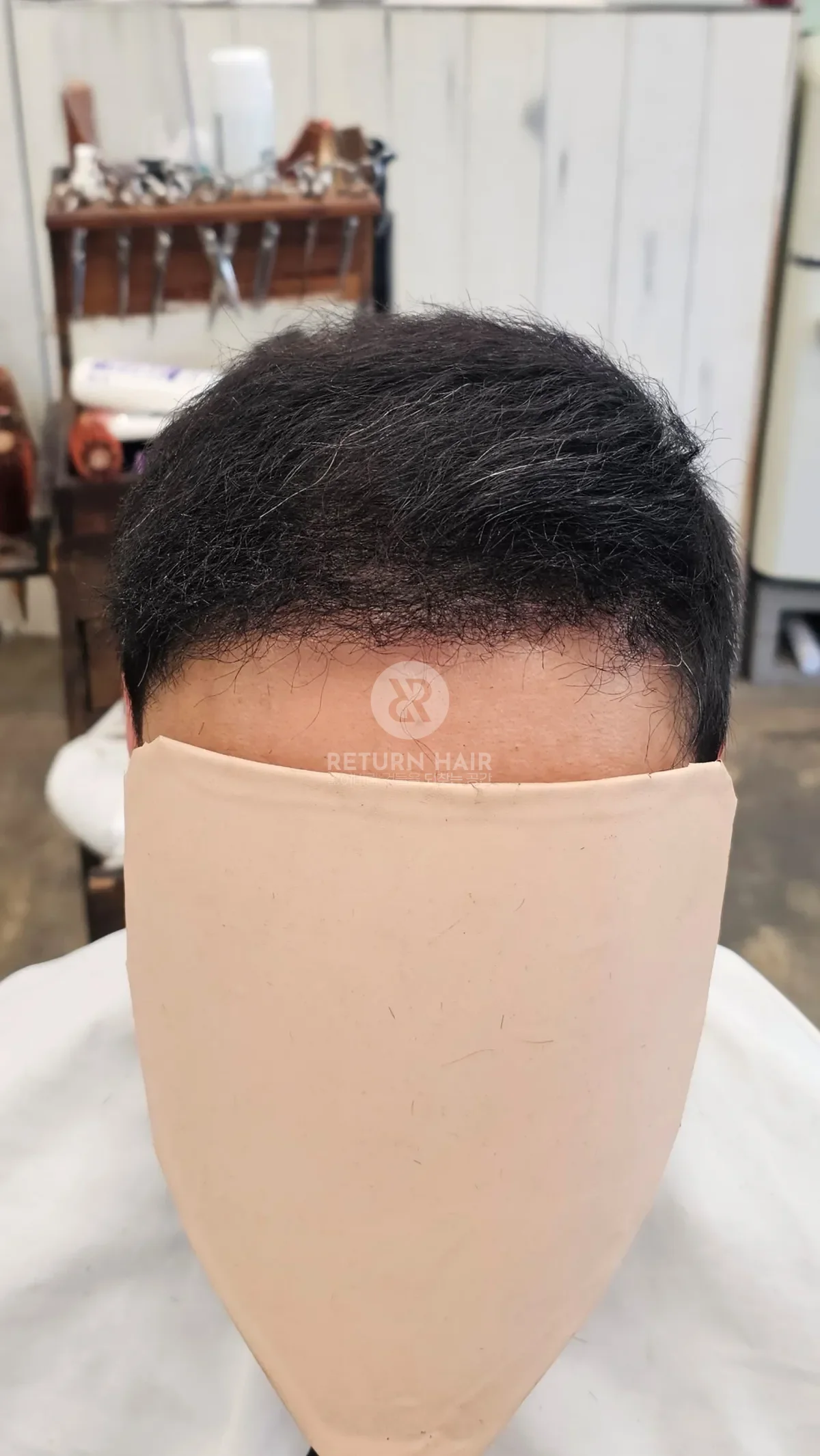 탈모 치트펌 파마 시술 후 결과 사진 2