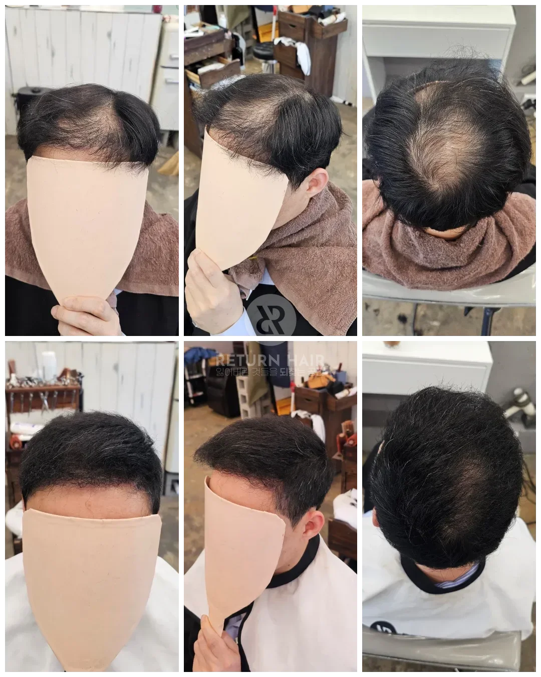 탈모 치트펌 파마 시술 후 결과 사진 6