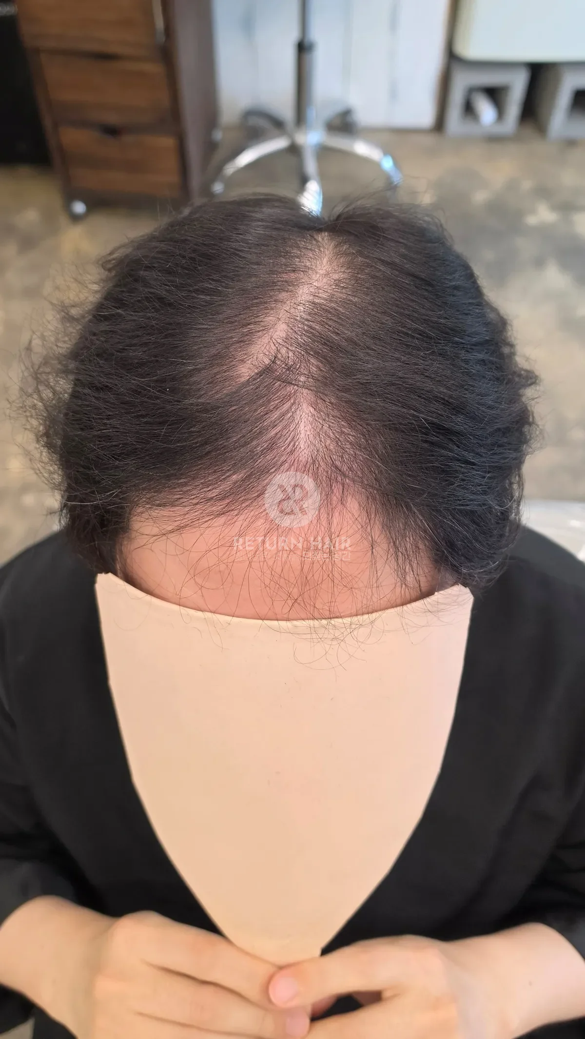 탈모 치트펌 파마 시술 전 사진
