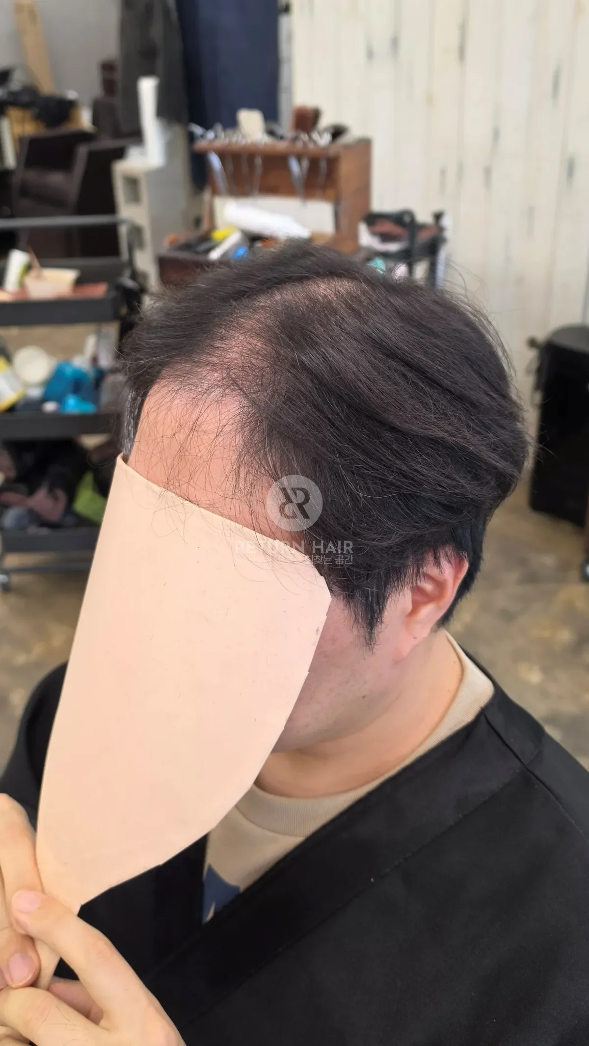 탈모 치트펌 파마 시술 전 사진 2