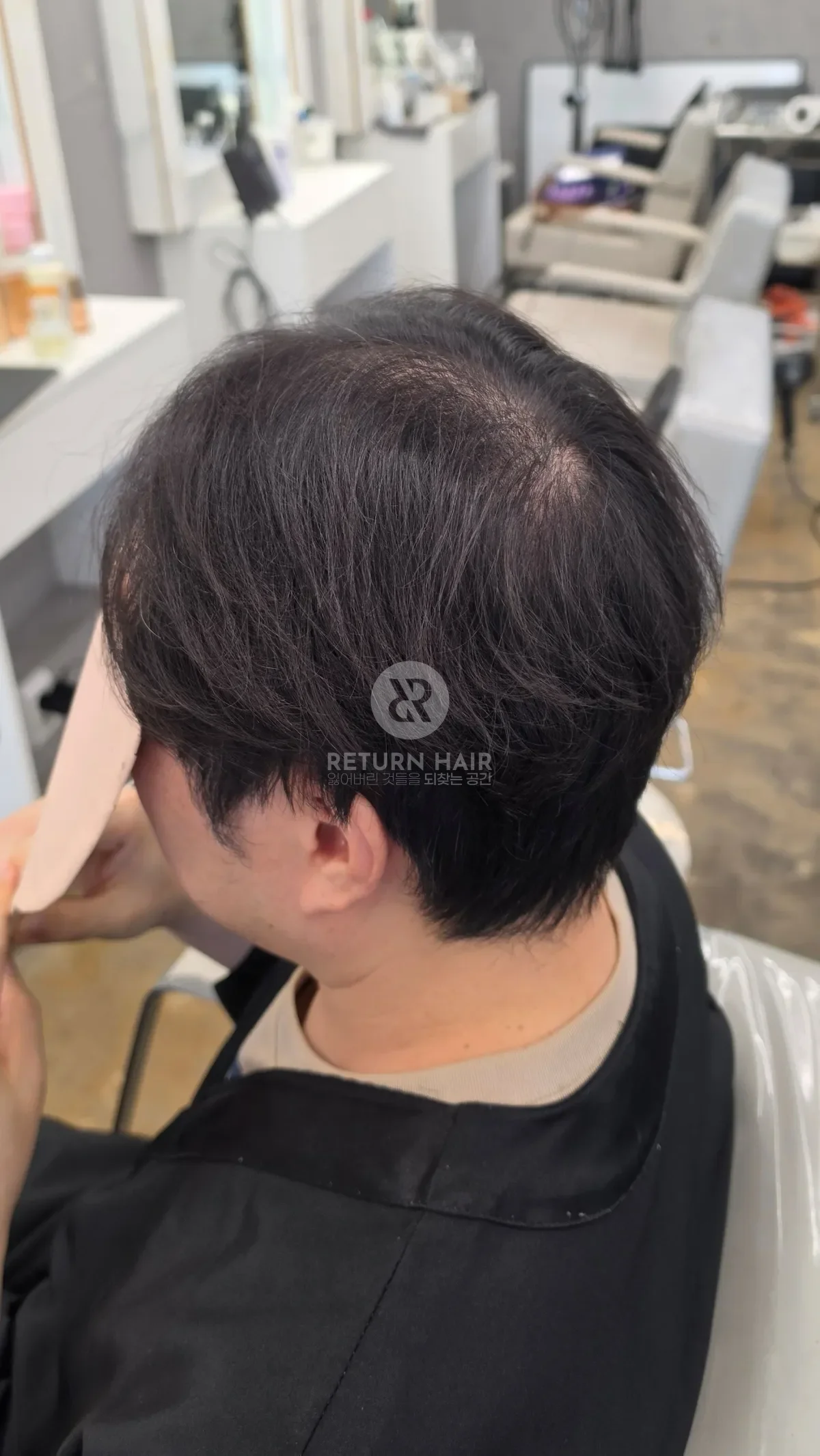 탈모 치트펌 파마 시술 전 사진 3