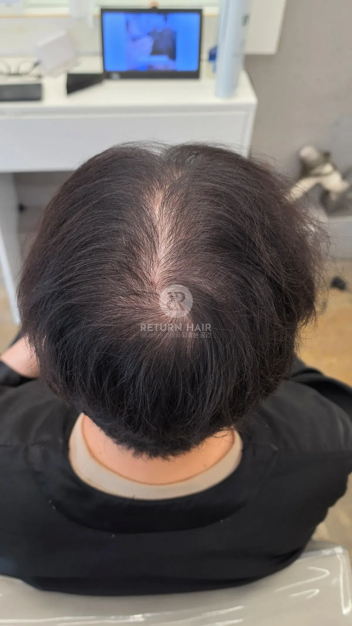 탈모 치트펌 파마 시술 전 사진 5