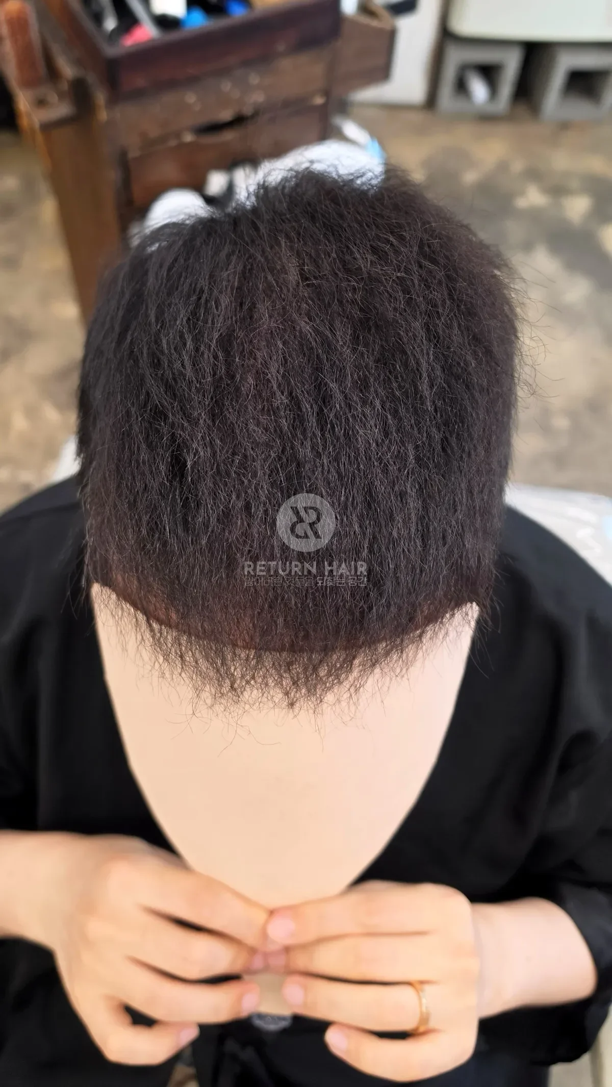 탈모 치트펌 파마 시술 후 결과 사진