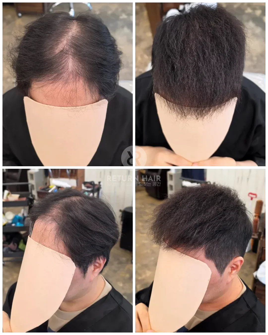탈모 치트펌 파마 시술 후 결과 사진 6