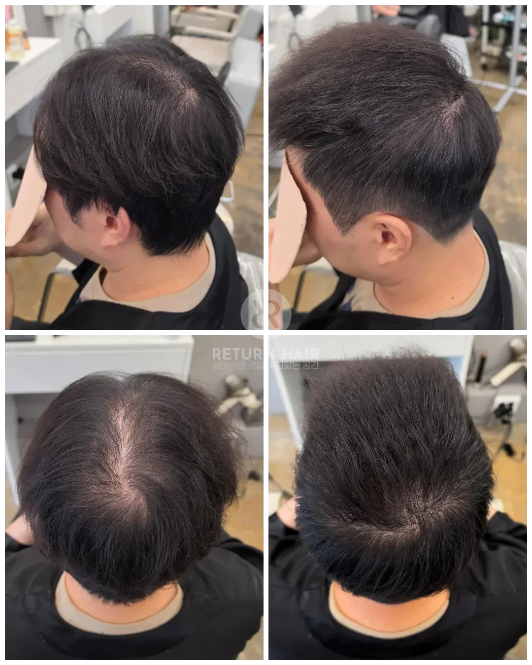 탈모 치트펌 파마 시술 후 결과 사진 7