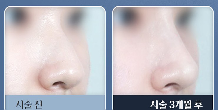 하이코 코프팅 시술 전과 시술 3개월 후 비교 1