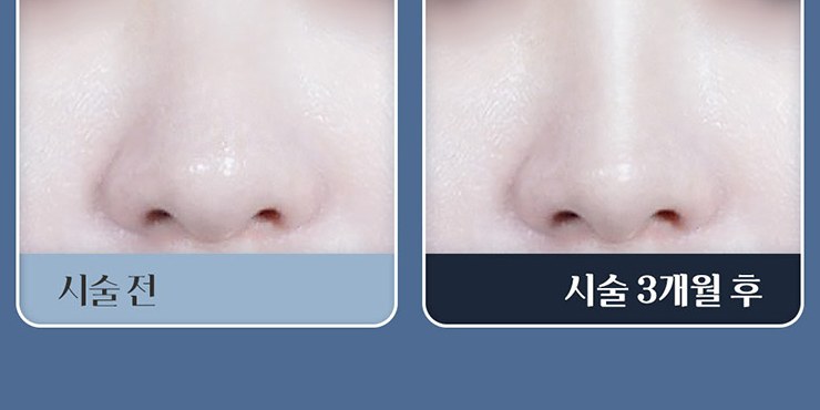 하이코 코프팅 시술 전과 시술 3개월 후 비교 3