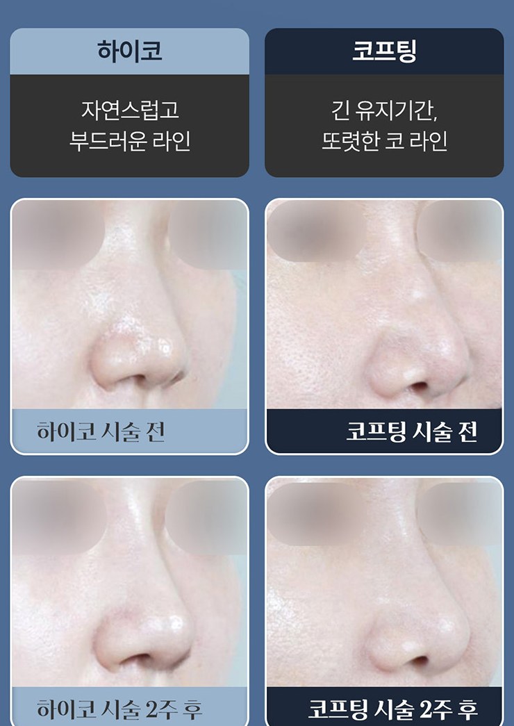 하이코(자연스럽고 부드러운 라인)와 코프팅(긴 유지기간, 또렷한 코라인) 시술 전후 비교
