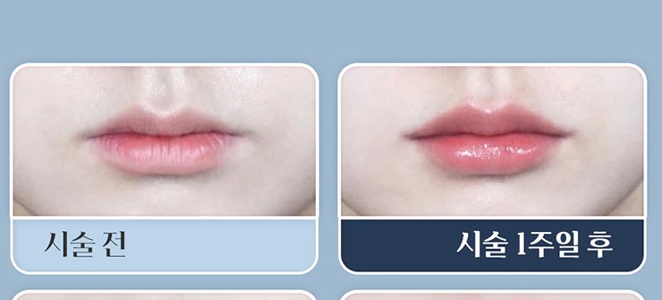 입술 필러 시술 전과 시술 1주일 후 비교 1