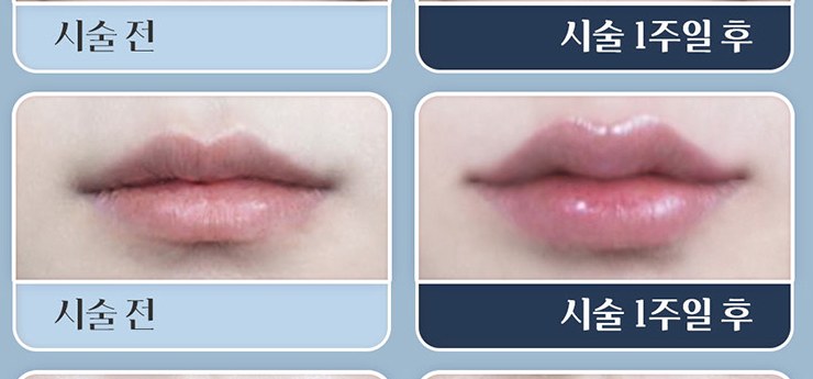 입술 필러 시술 전과 시술 1주일 후 비교 2