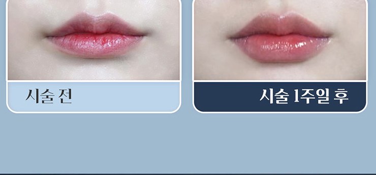 입술 필러 시술 전과 시술 1주일 후 비교 3
