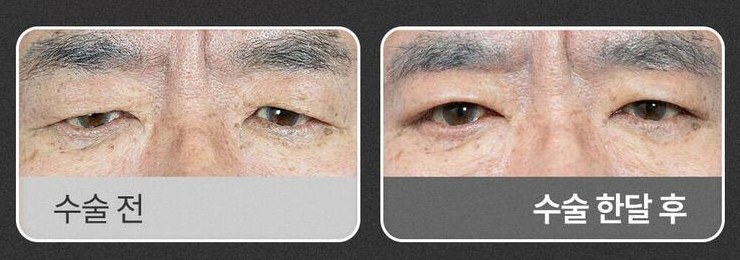 눈썹하거상 수술 전과 수술 한달 후 비교