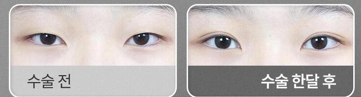 매몰 쌍꺼풀 수술 전과 수술 한달 후 비교