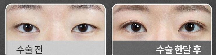 절개 쌍꺼풀 수술 전과 수술 한달 후 비교