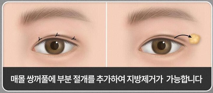 매몰 쌍꺼풀에 부분 절개를 추가하여 지방제거가 가능합니다